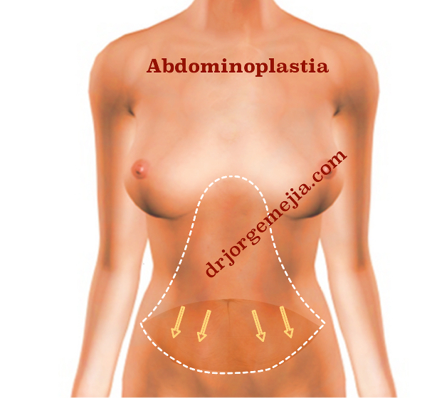 abdominoplastia general w