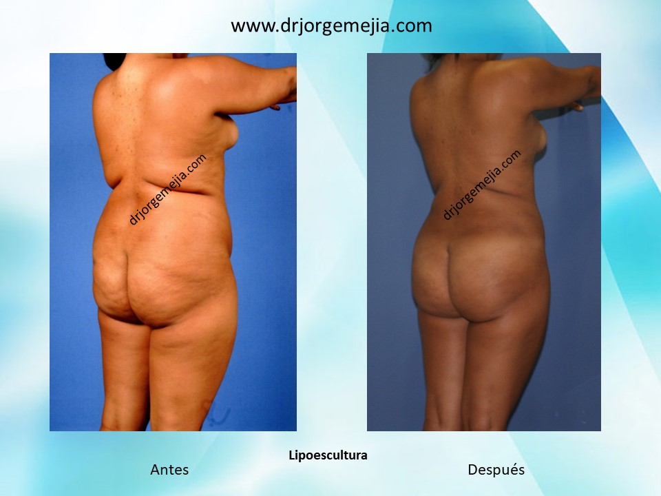 Lipoescultura o liposucción – Cirugía Estética Medellín Colombia – Dr.  Jorge Mejía